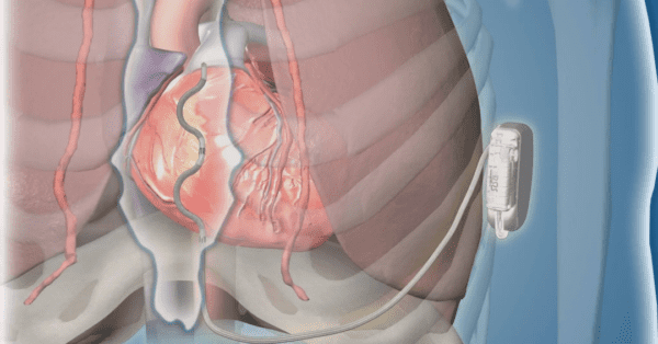 Medtronic's Defibrillation Innovation - Cardiac Wire