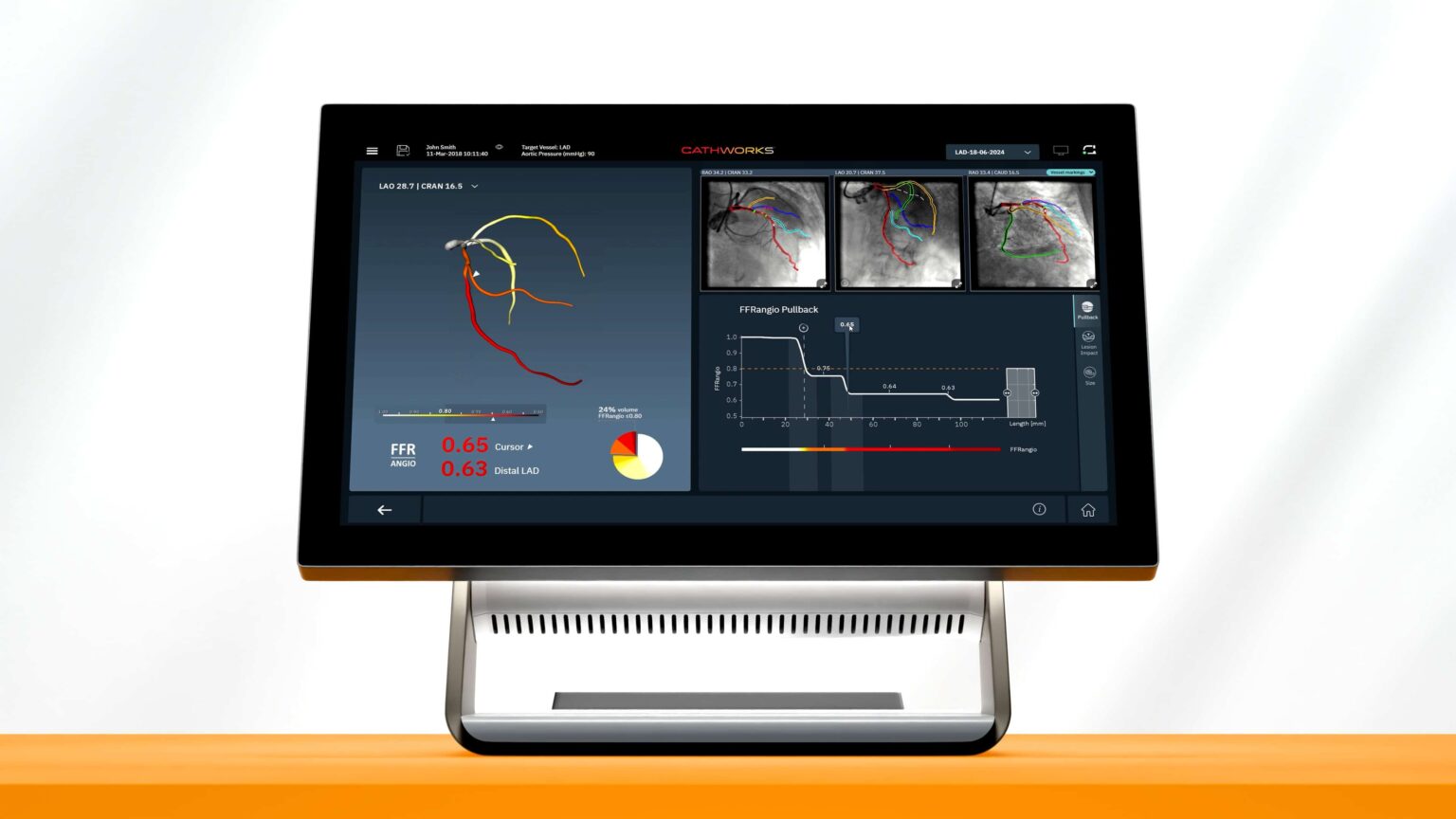 CathWorks FFRangio Goes Beyond Physiology - Cardiac Wire